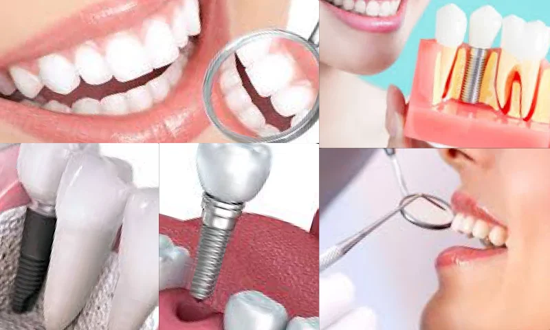 İmplant Diş Tedavisi İle Sağlıklı Bir Gülüşe Sahip Olun